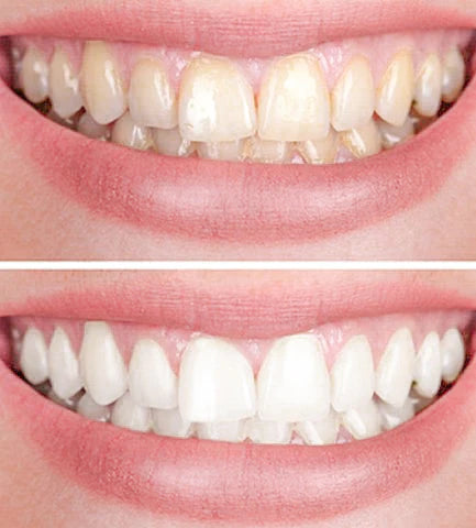 PureSmile™ Smile Ready Anytime