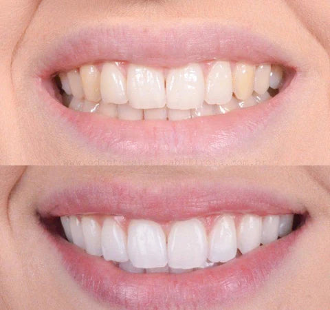 PureSmile™ Smile Ready Anytime