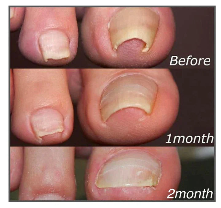 NailCure™Strengthen Restore Protect