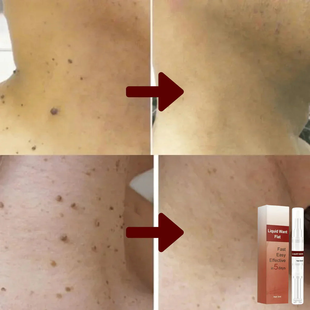 1+1 Free | MoleAway™ Painless Tag Removal
